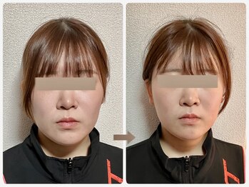 哲心 姫路/1回の施術でエラ張りが改善☆
