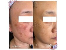 アルルプラス 南草津(ARuru+)の雰囲気（シミ、たるみ改善　結果重視究極のエイジングケア）