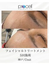 ユミト(Umit)/プロセルフェイシャル