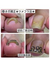 マニュコクーン(ManuCocoon)/爪育成　深爪　巻き爪　大阪市