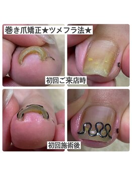 マニュコクーン(ManuCocoon)/爪育成 深爪 巻き爪 大阪市