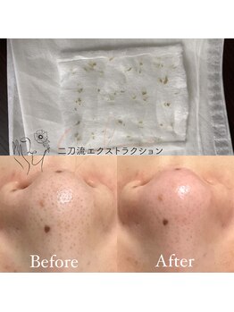 毛穴ケアサロン そらな/毛穴汚れをご覧頂けます!