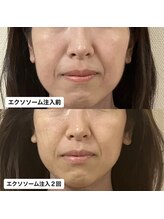 グラン ジュテ/臍帯エクソソーム注入