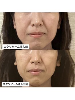 グラン ジュテ/臍帯エクソソーム注入