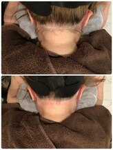 ビープラス(B plus)/うなじWAX脱毛で理想のうなじへ