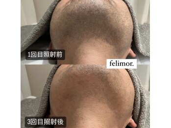 フェリモール(Felimor.)/メンズ光脱毛