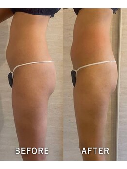 オーロラ(Aurora)/痩身ダイエットコースの1回目