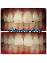 ホワイトニングショップ 西尾店/Before&After西尾ホワイトニング