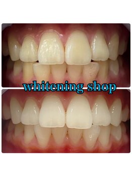 ホワイトニングショップ 西尾店/Before&After西尾ホワイトニング