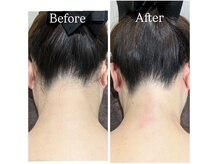 オベリオ(Oberio)/うなじ脱毛