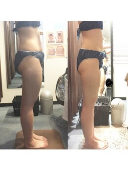 ビーフィール 府中店(be feel)/脂肪冷却でお尻・太腿もスッキリ