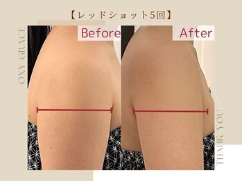 オキシー グレイス 小倉店(OXY Grace)/レッドショット5回