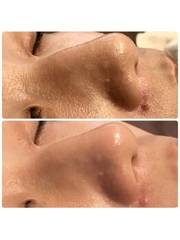 ティアーナ(Tiaana)/毛穴洗浄