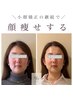 今だけ！モニター募集【小顔+リフトアップ】たるみ改善小顔矯正/¥6600×4回