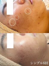 小顔フェイスラボ 鈴鹿店(小顔FaceLabo.)/◆毛穴改善・ニキビケア◆