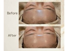 アンダブル(Andouble)/ビフォーアフター（お顔剃り）