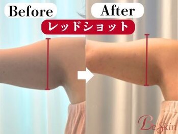 ビースキン 広島(BE:SKIN)/レッドショット/二の腕/引締め