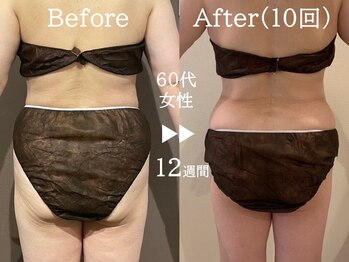 セレブリボーン 大阪ボーテ/サーモシェイプDEEP