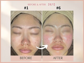 シンスプラス(SINCE+)/毛穴集中改善コース