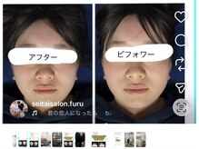フル(FURU)/小顔矯正