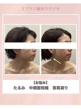 ミプラス鍼灸スタジオ/ビフォーアフター