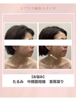 ミプラス鍼灸スタジオ/ビフォーアフター