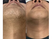 メリアミーゴ(Meli amigo)/【メンズ】ヒゲ脱毛