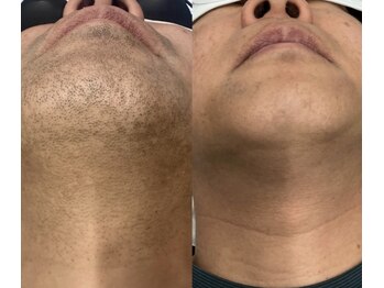 メリアミーゴ(Meli amigo)/【メンズ】ヒゲ脱毛