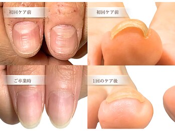 リケアネイル(Re:care nail)の写真/自爪育成/巻き爪ケアでお悩みを解消☆