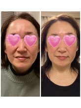 ルピナージュ(Lupinage)/エクソソーム美容液の施術