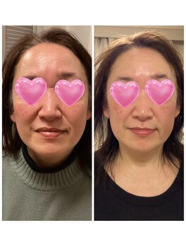 ルピナージュ(Lupinage)/エクソソーム美容液の施術