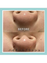 リュミエール(Lumiere)/角栓放置は黒ずみのもと！？