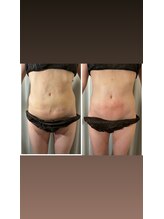 アヌヘア(Anuhea)/京都で1番のインディバ術ケア