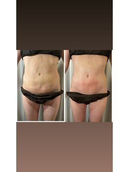 アヌヘア(Anuhea)/京都で1番のインディバ術ケア