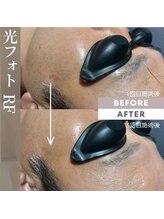 ルアナ(LUANA。)/光フォトRFビフォーアフター
