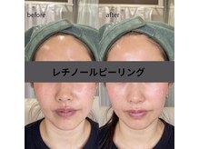 ボン セジュール(Bon sejour)/レチノールララピール