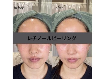 ボン セジュール(Bon sejour)/レチノールララピール