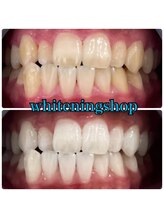 ホワイトニングショップ 西尾店/Before&After西尾ホワイトニング