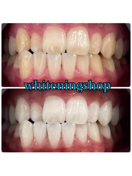 ホワイトニングショップ 西尾店/Before&After西尾ホワイトニング