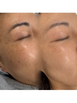 ラ クレール ビューティーサロン(LA CLAIR)/ホワイトラボ2回施術