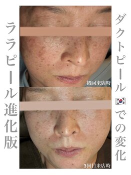 シュシュ(chouchou)/ダクトピール 3回目