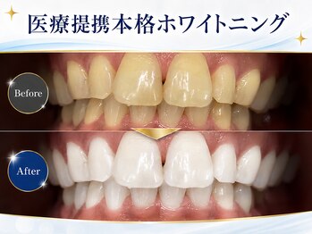 メルヴェイユ/本格医療提携ホワイトニング
