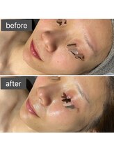 ロッタ エクリュ(Lotta ecru+)/REVI剥けないハーブピーリング