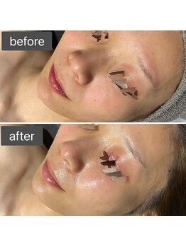 ロッタ エクリュ(Lotta ecru+)/REVI剥けないハーブピーリング