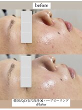 クレヴィー(Creviy)/韓国式3D毛穴洗浄×ハーブ1回