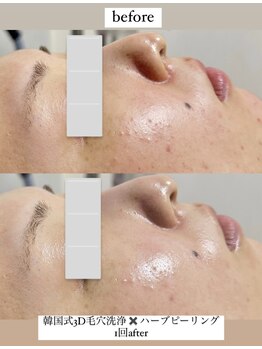 クレヴィー(Creviy)/韓国式3D毛穴洗浄×ハーブ1回