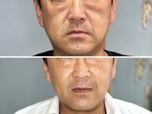 ハス(hasu.)/たるみ改善　3回目