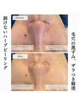 ラヴェンナサロン 札幌店(Ravenna salon)/毛穴、黒ずみケア♪