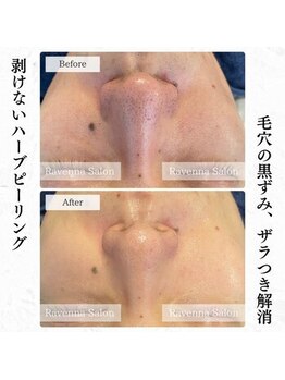 ラヴェンナサロン 札幌店(Ravenna salon)/毛穴、黒ずみケア♪