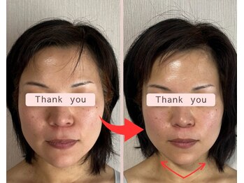 リセル(Recell)/小顔☆脂肪分解